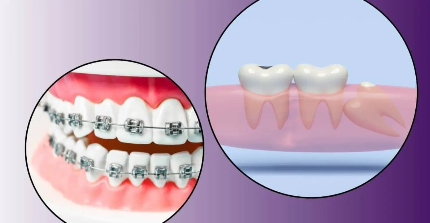 is wisdom teeth orthodontic 2