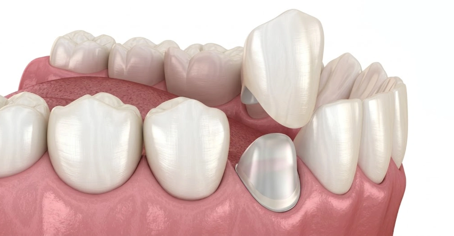 How are new dental crowns made