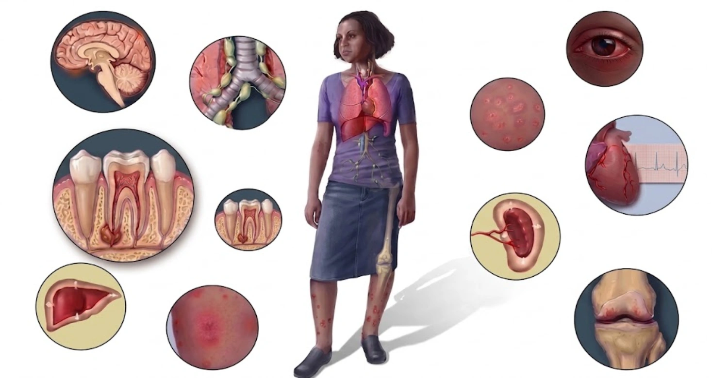 Sarcoidosis and dental extraction