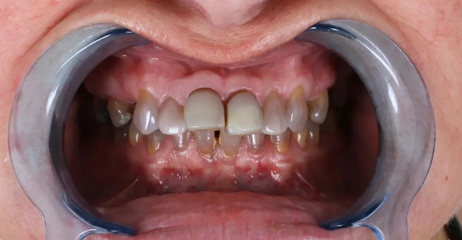 What causes teeth to turn dark? - Vitrin Clinic