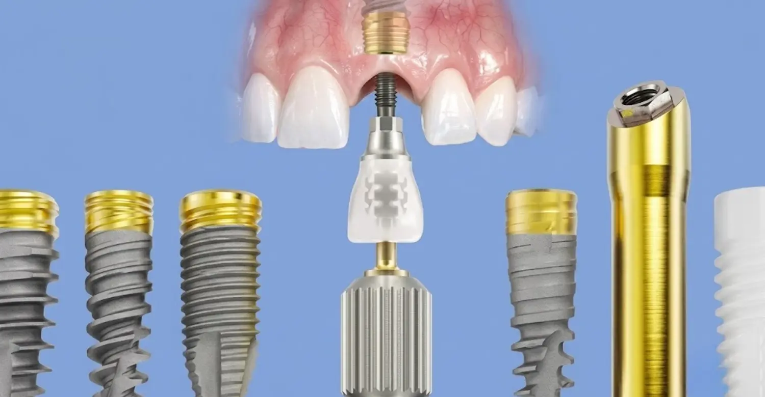 Nobel Biocare Dental Implants: Expert Guide - Vitrin Clinic