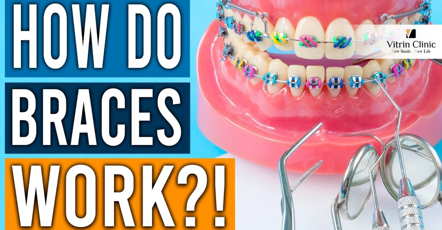 Braces Process How Do Braces Work? Orthodontic Guide - Vitrin Clinic