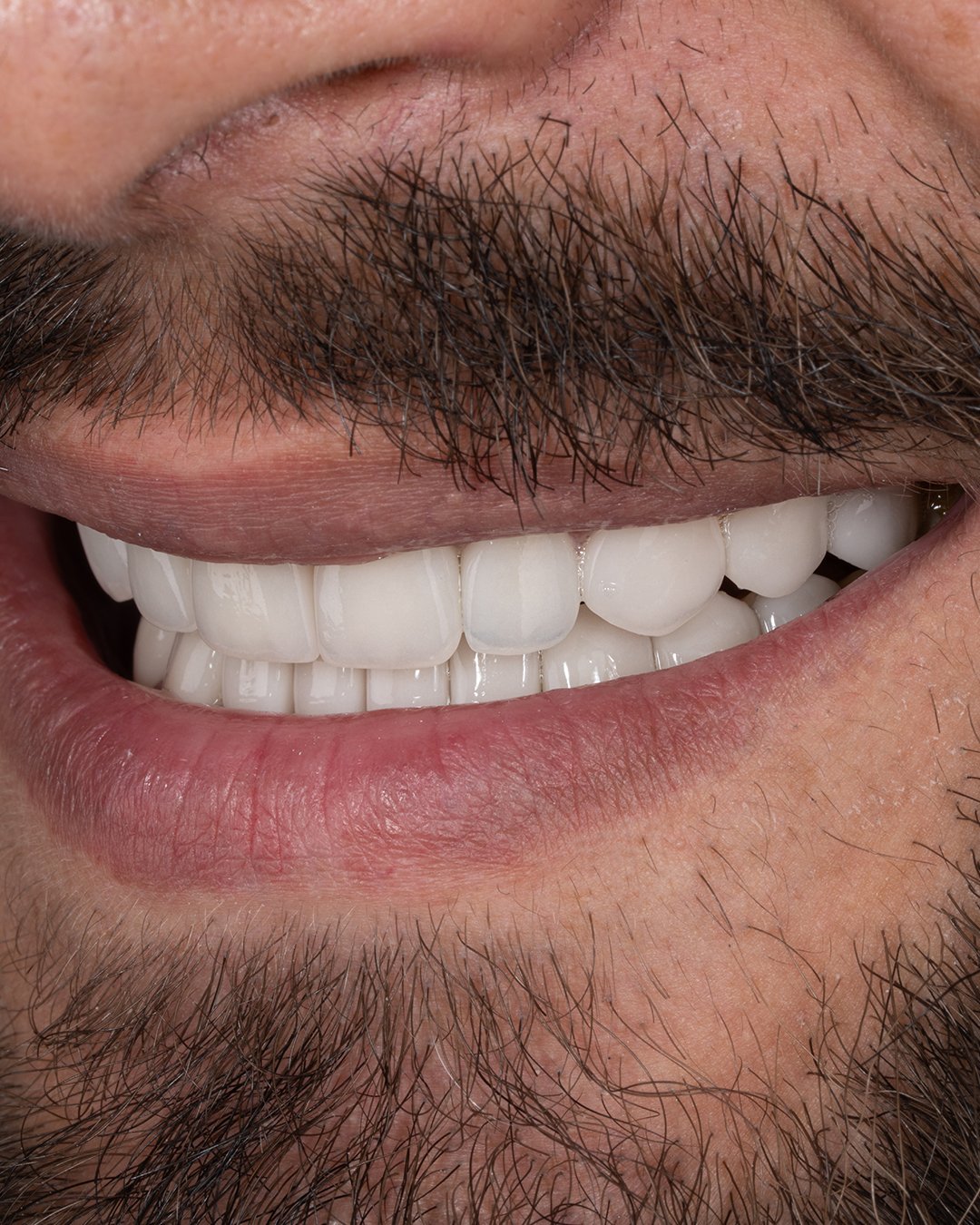 Invisalign può correggere un morso profondo (overbite)?
