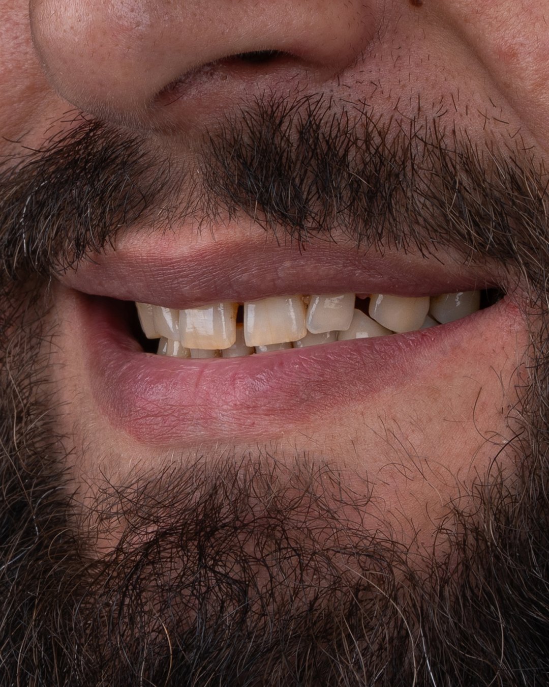 Invisalign può correggere un morso profondo (overbite)?