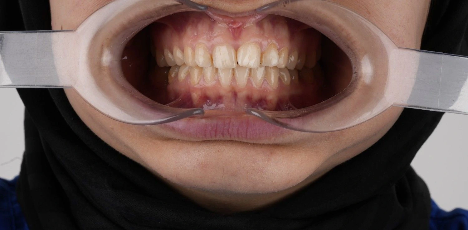Before treatment 1