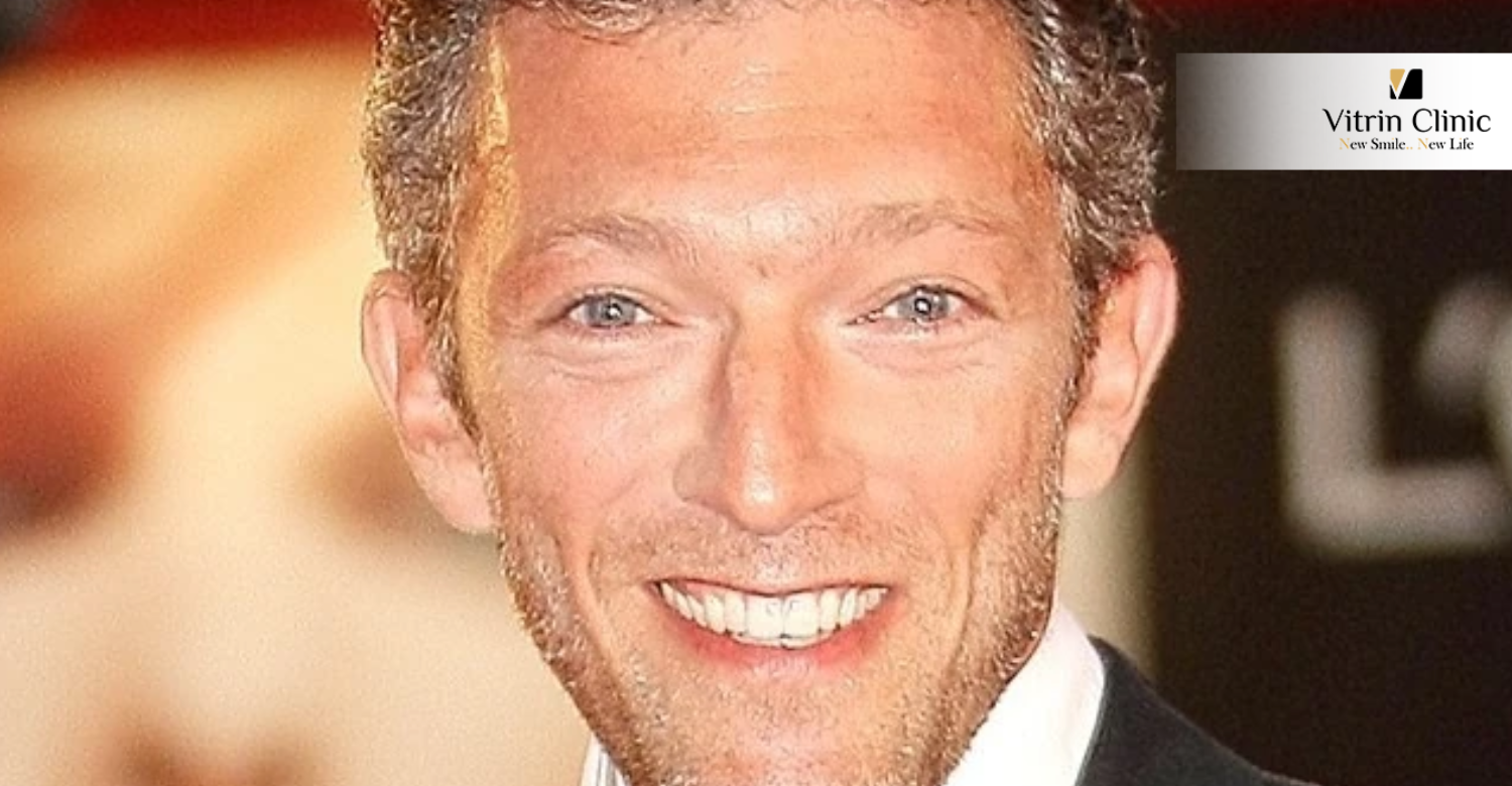 Vincent Cassel dents