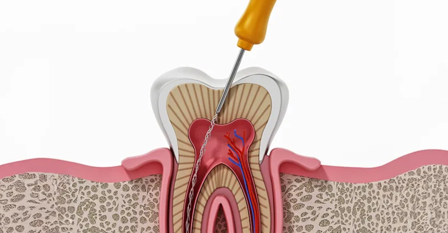 Is a Root Canal a Surgery? and Do You Really Need One? - Vitrin Clinic