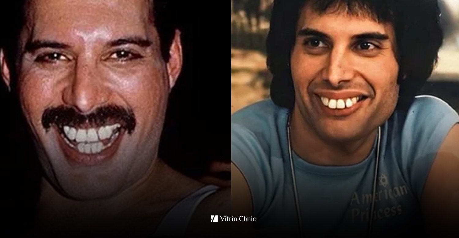 Perché i denti di Freddie Mercury erano così indimenticabili? 5 fatti affascinanti del 2026