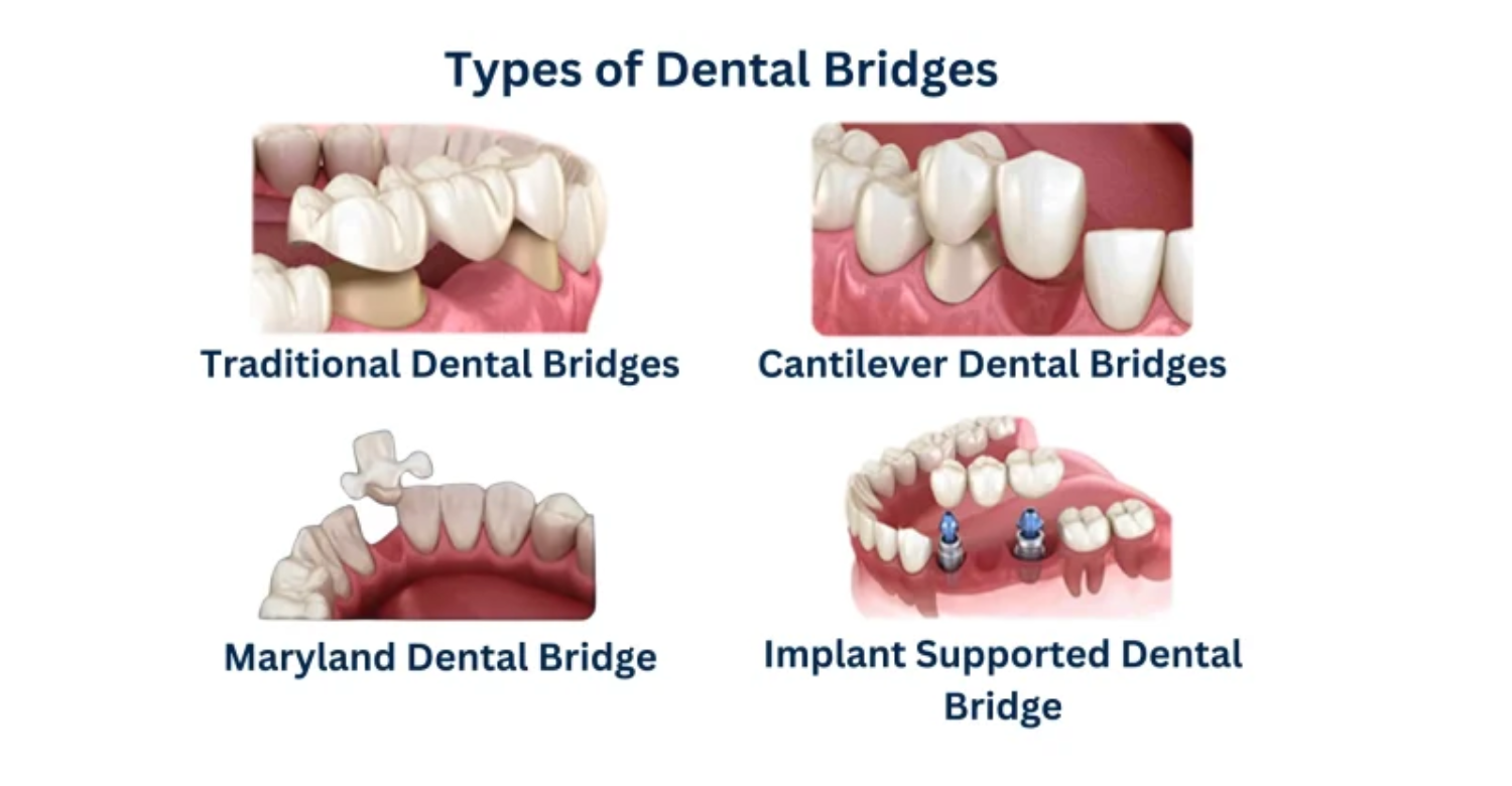 4 Best Types of Dental Bridges Guide - Vitrin Clinic