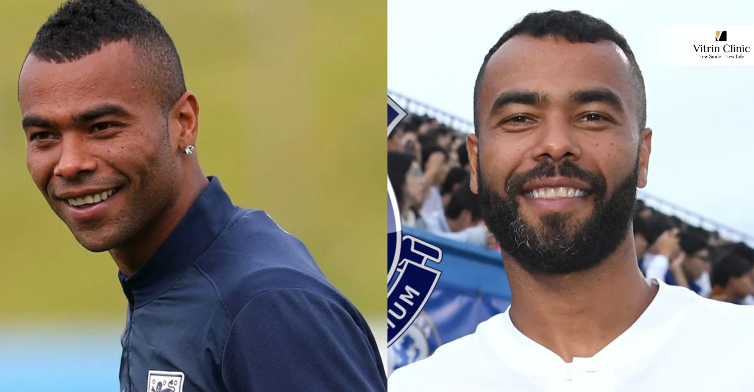 L'evoluzione del sorriso di Ashley Cole