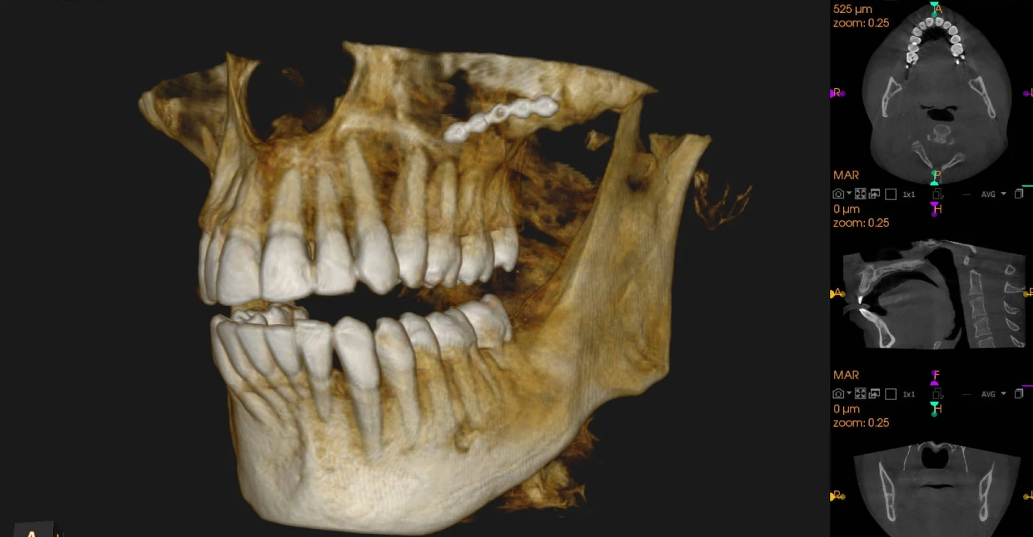 CBCT Scan Dental Images Advanced 3D Guide - Vitrin Clinic