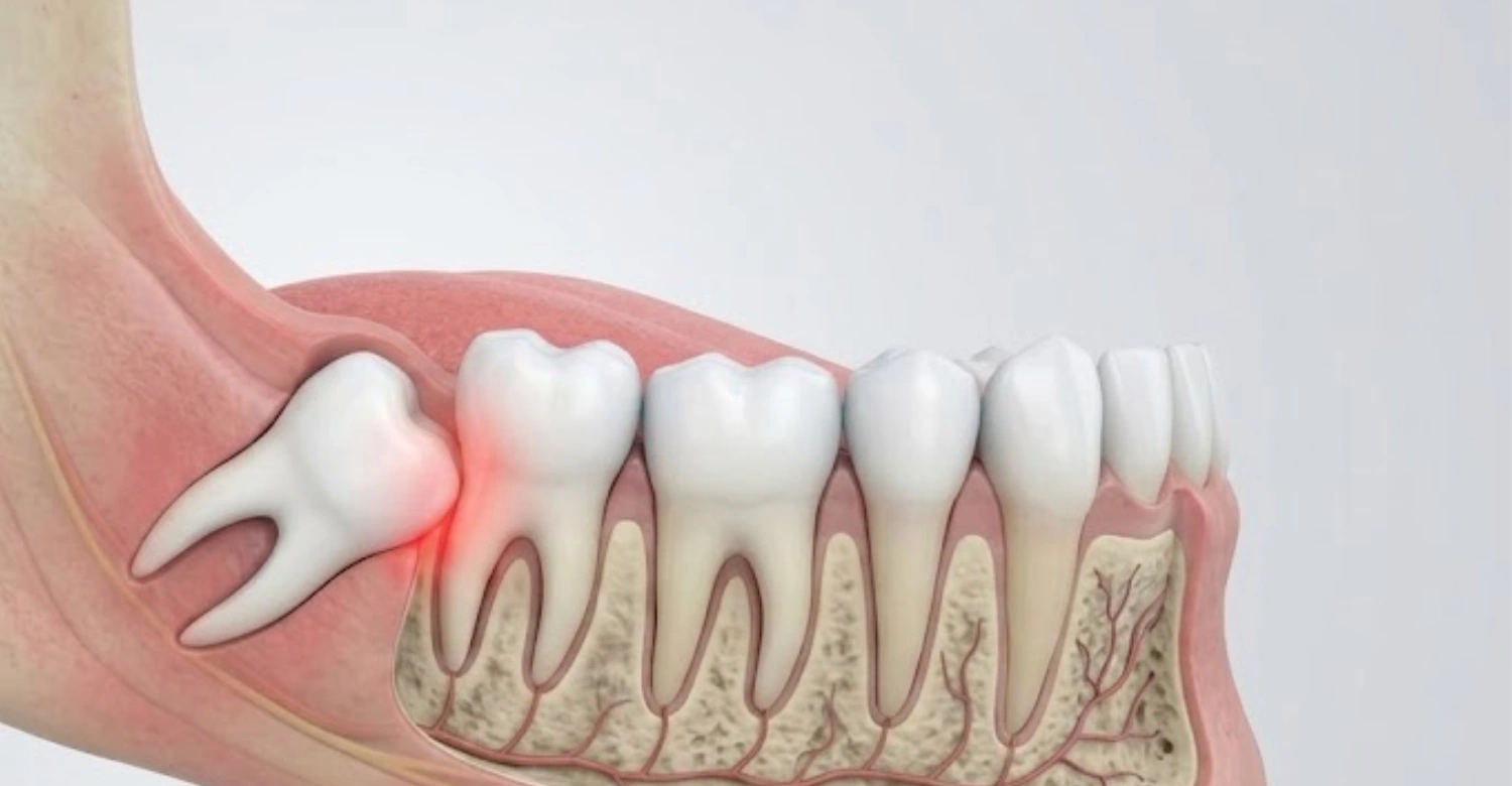 Swollen gums around wisdom tooth
