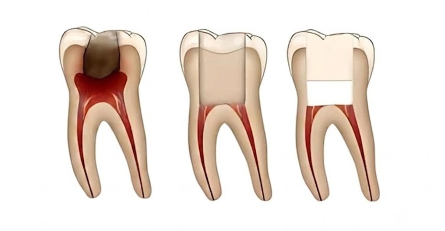pulp capping vs root canal