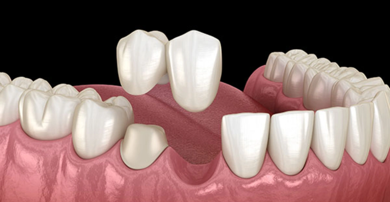What is a dental cantilever bridge? Guide - Vitrin Clinic