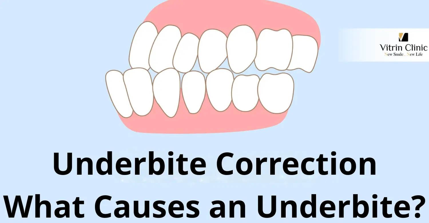 Underbite Correction Options for All Ages - Vitrin Clinic