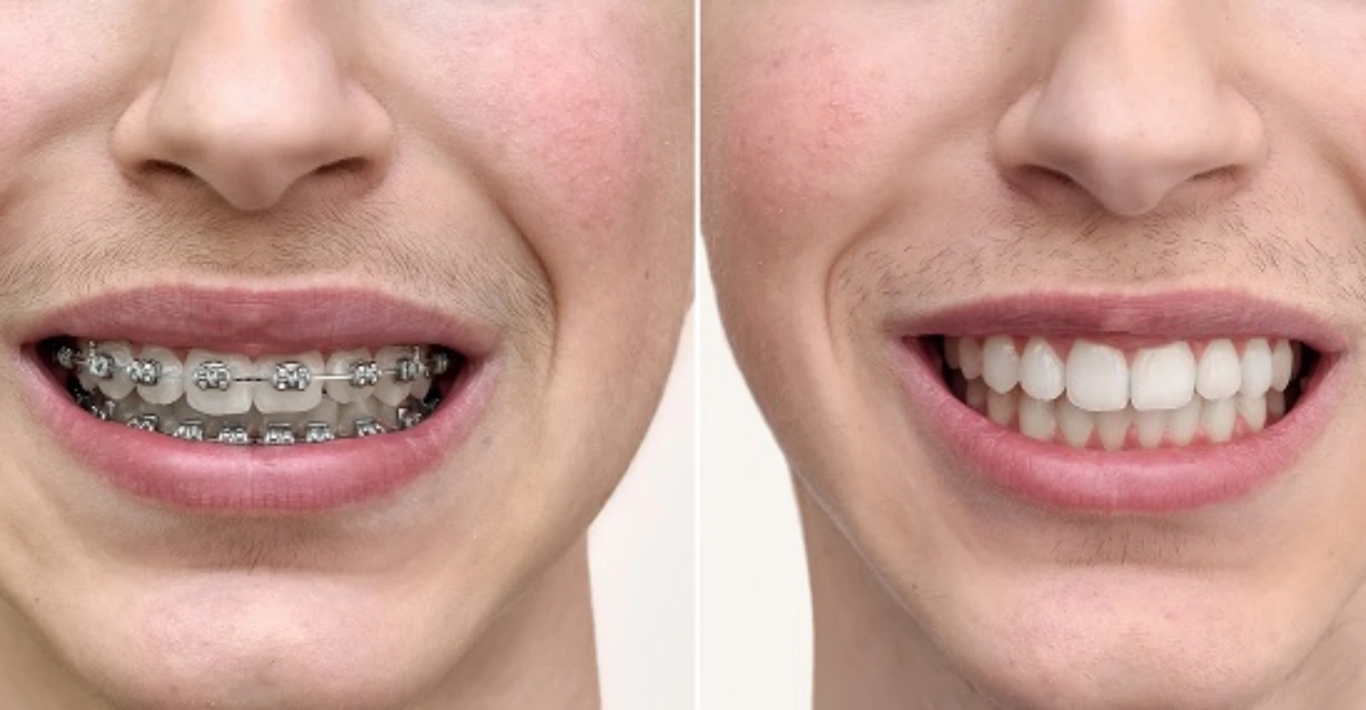 Guía de costos de brackets