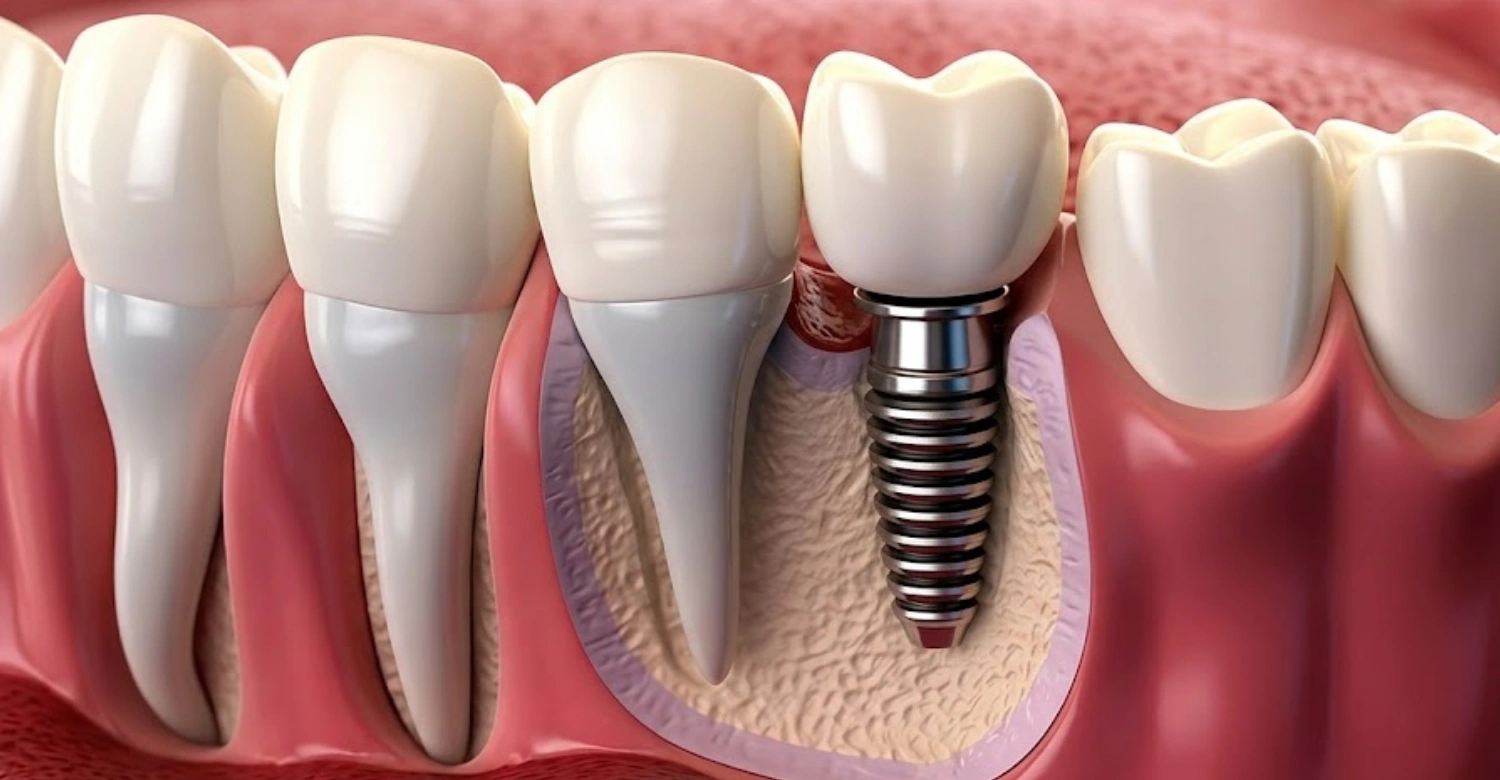 What Are Dental Posts and When Are They Needed for Tooth Restoration ...