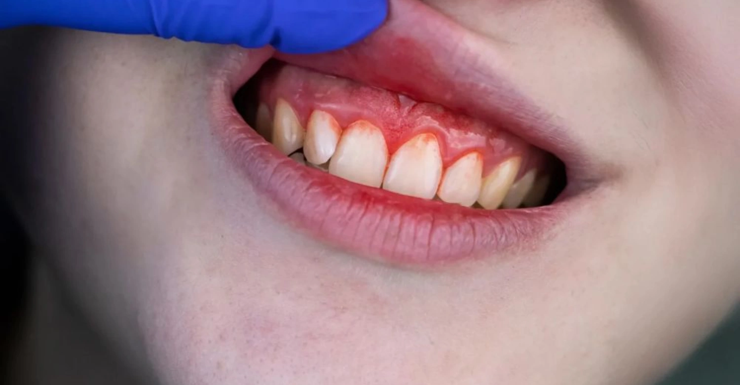 Red Spot on Gums Above Tooth - Vitrin Clinic