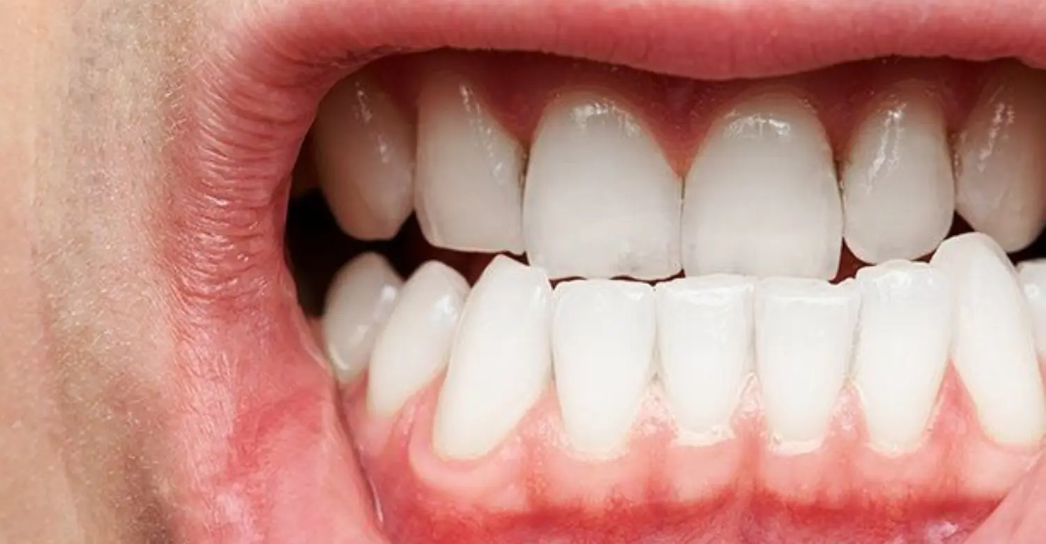 Causes of Dark Red Gums Below Teeth - Vitrin Clinic