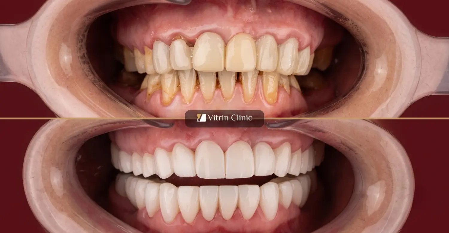 Wirkt ein Hollywood Smile künstlich? Die klinische Wahrheit hinter natürlich wirkenden Smile-Makeovers