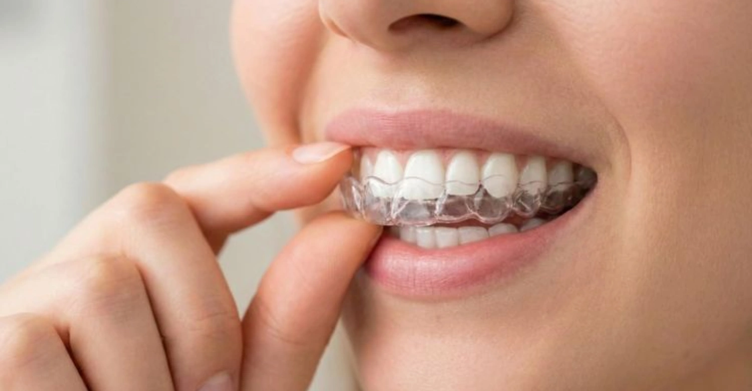 Night Guard for Bruxism1