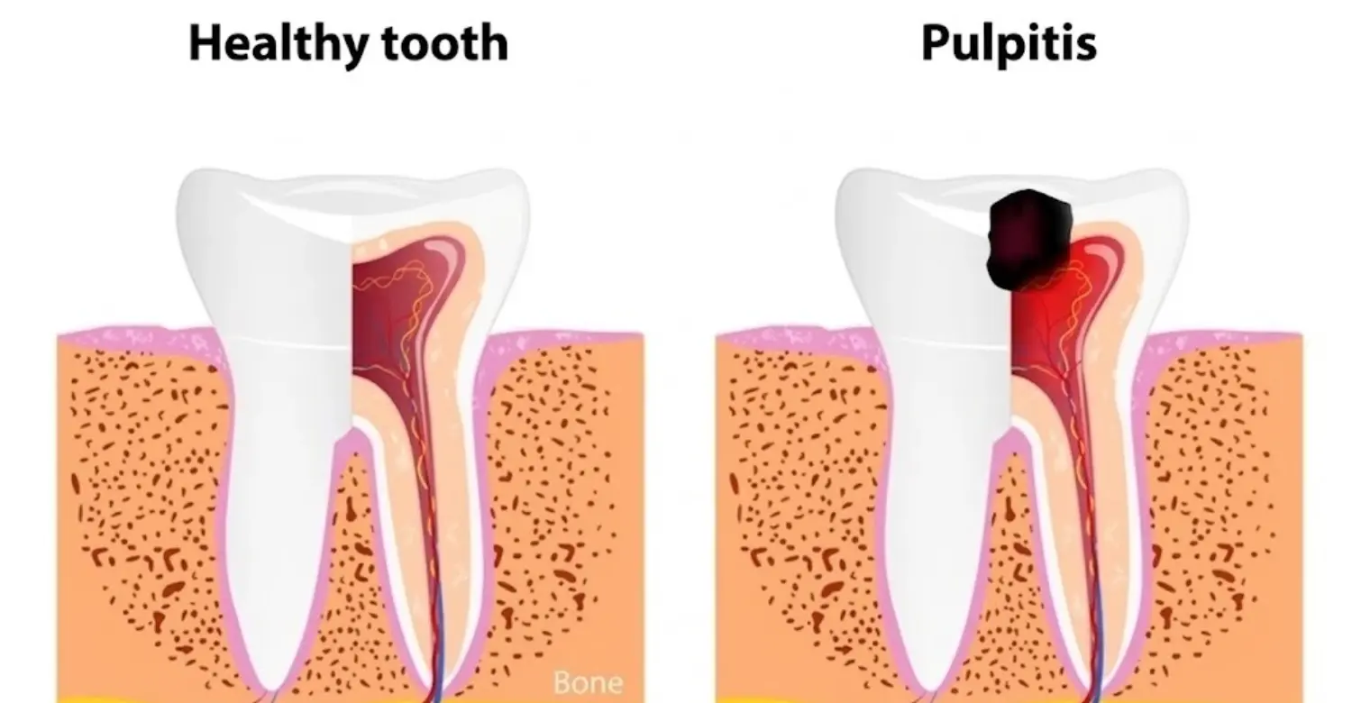 ¿Qué es la pulpitis irreversible y cómo se trata? - Clínica Vitrin