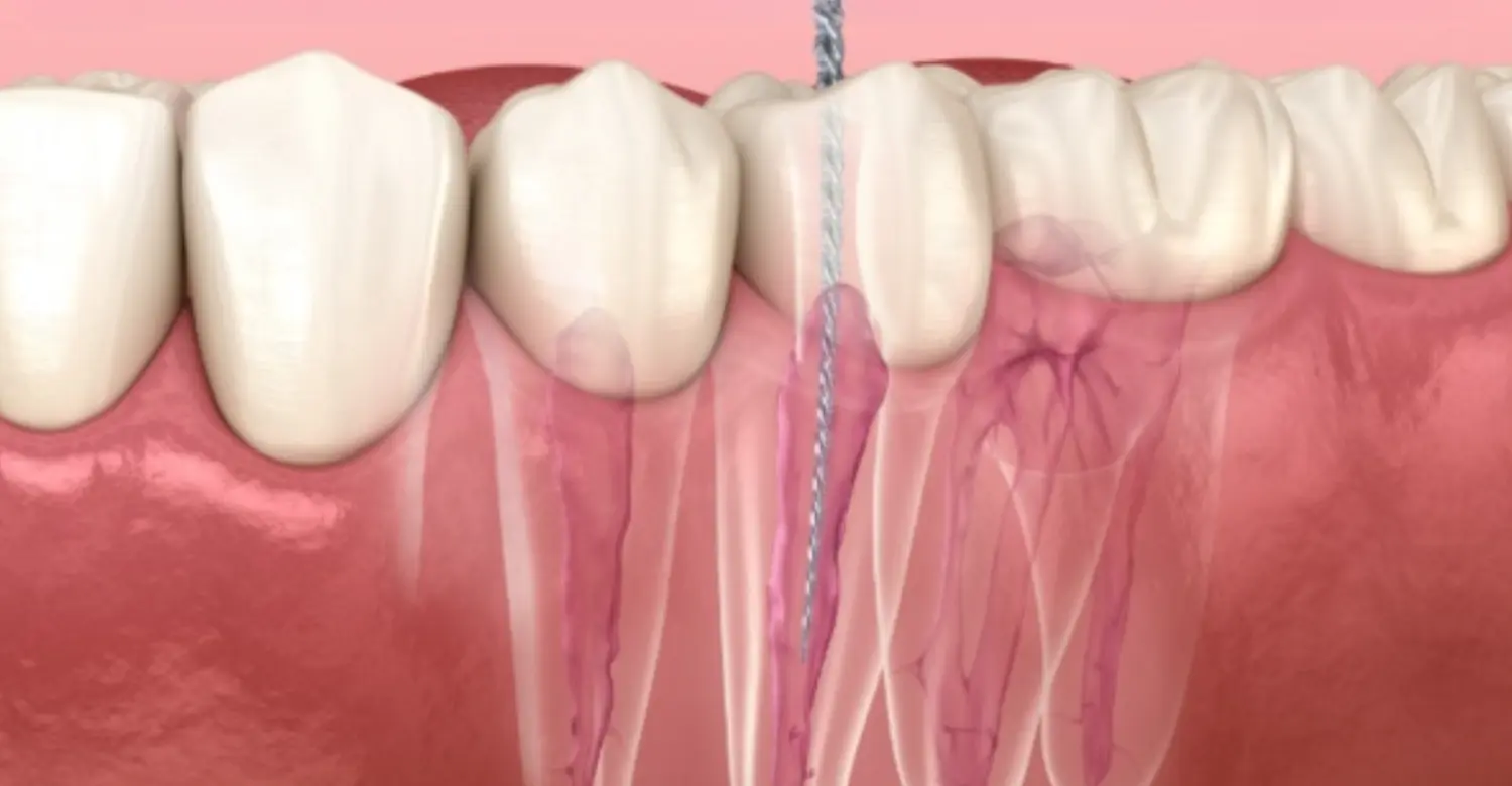 what does needing a root canal feel like