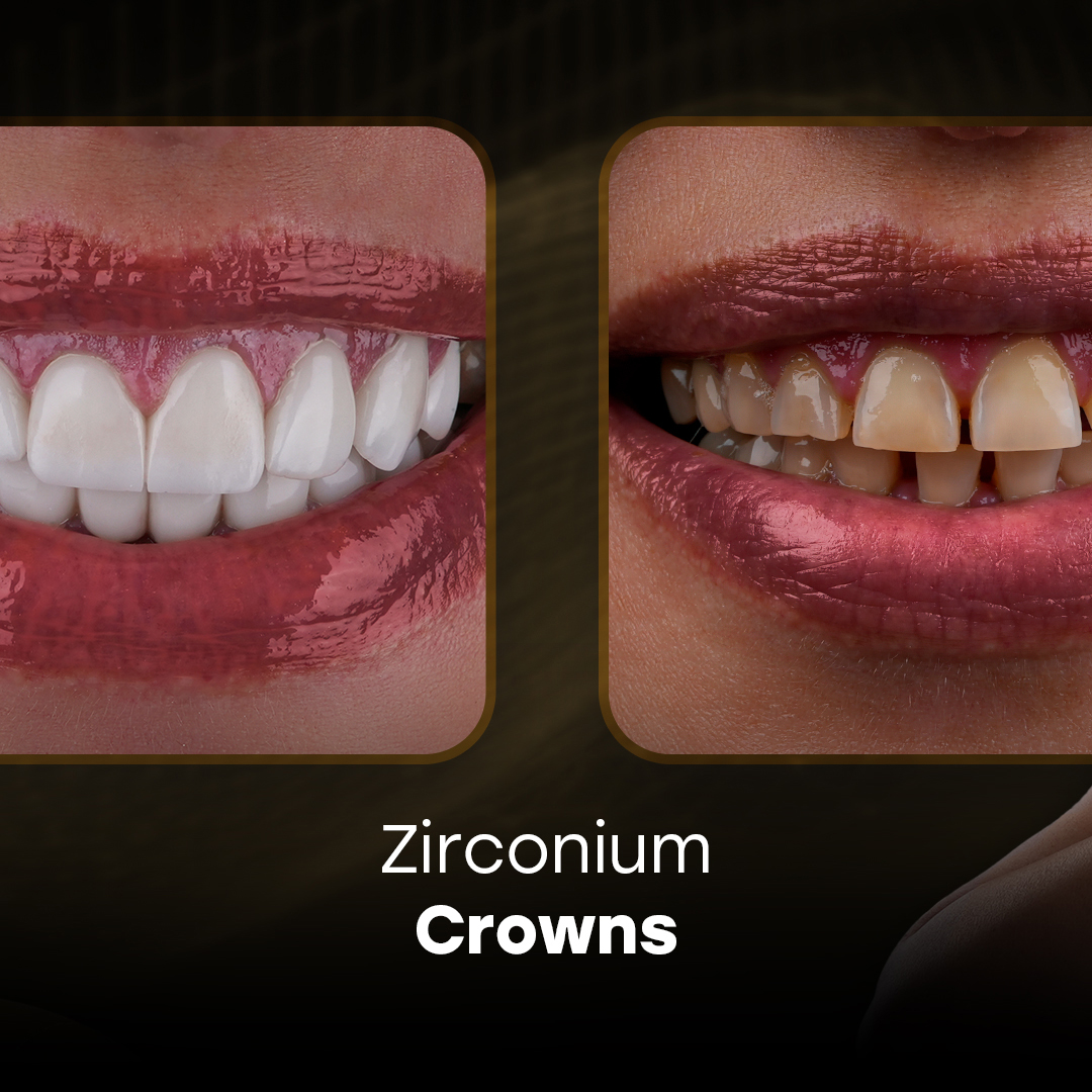root canal vs filling