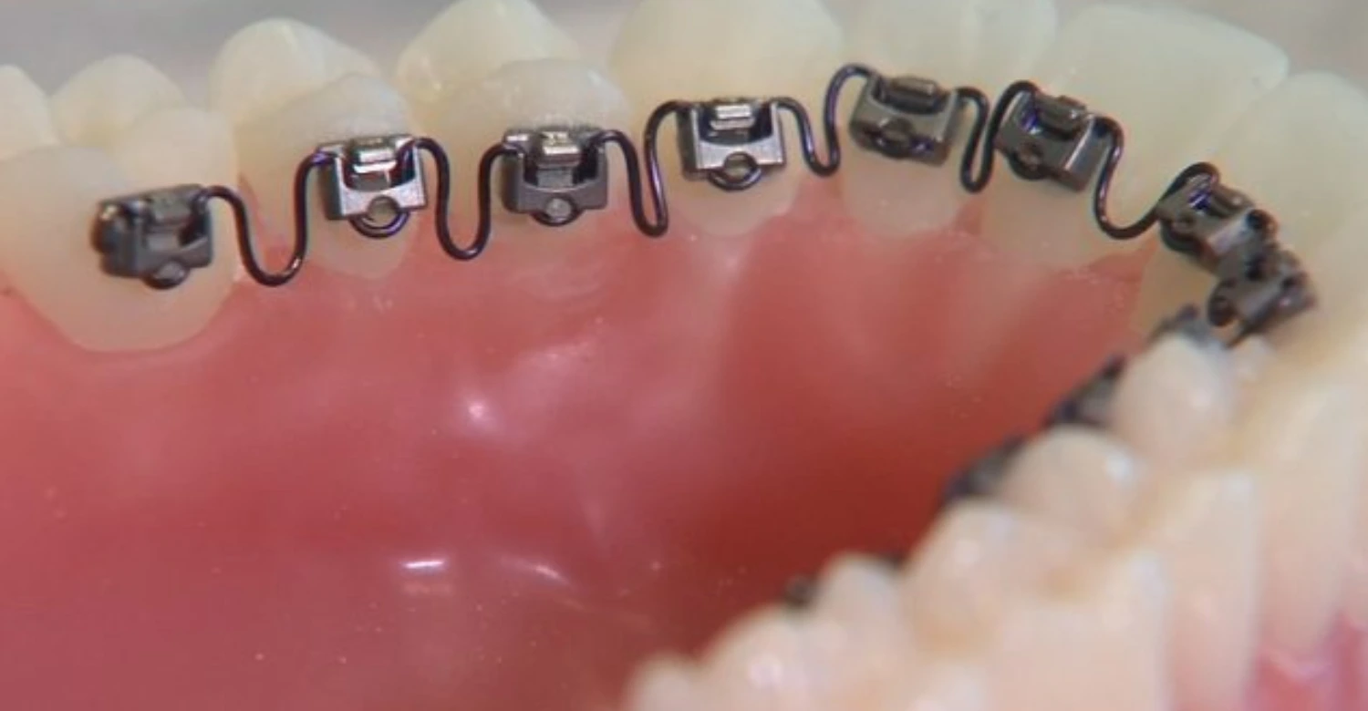 Benefits of Hidden Inner Teeth Braces - Vitrin Clinic