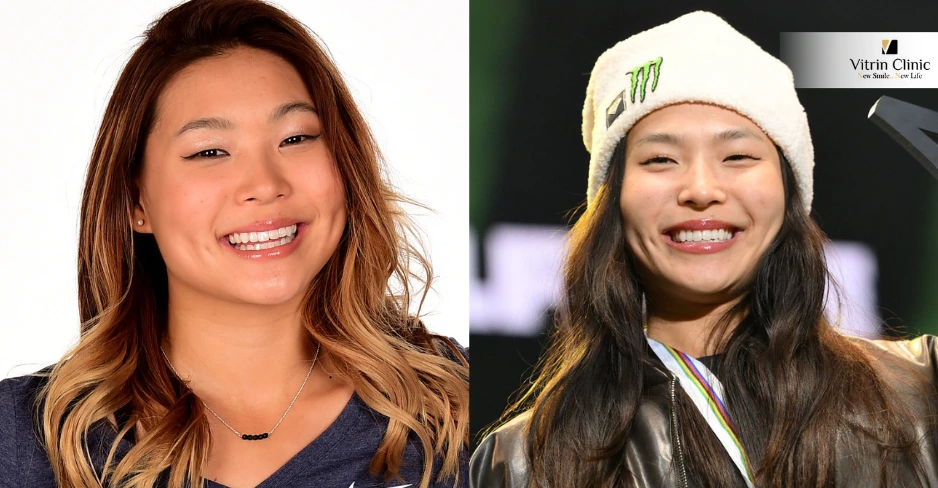Sonrisa de Chloe Kim Antes y Después: Un Análisis Detallado