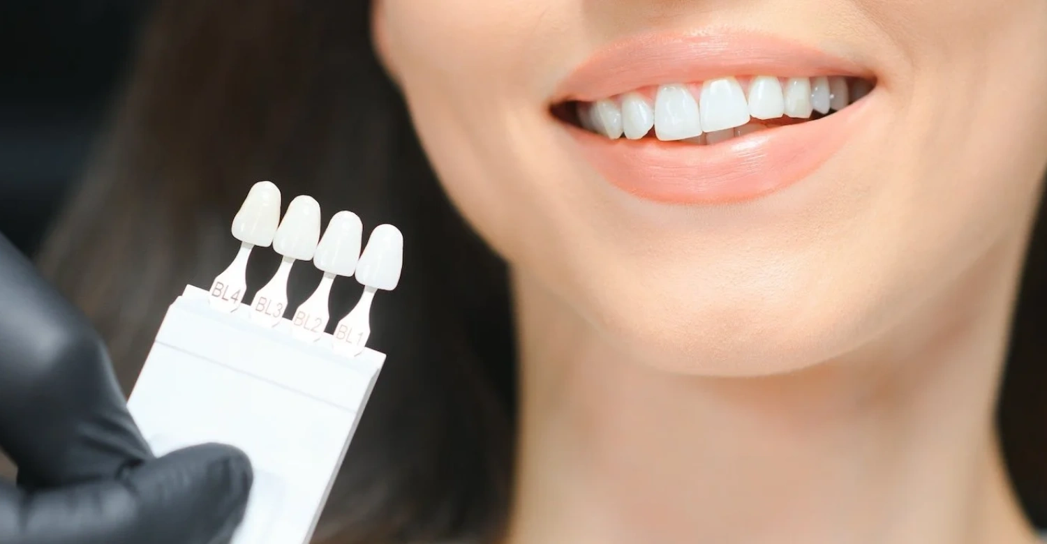 Veneers Recovery First Week