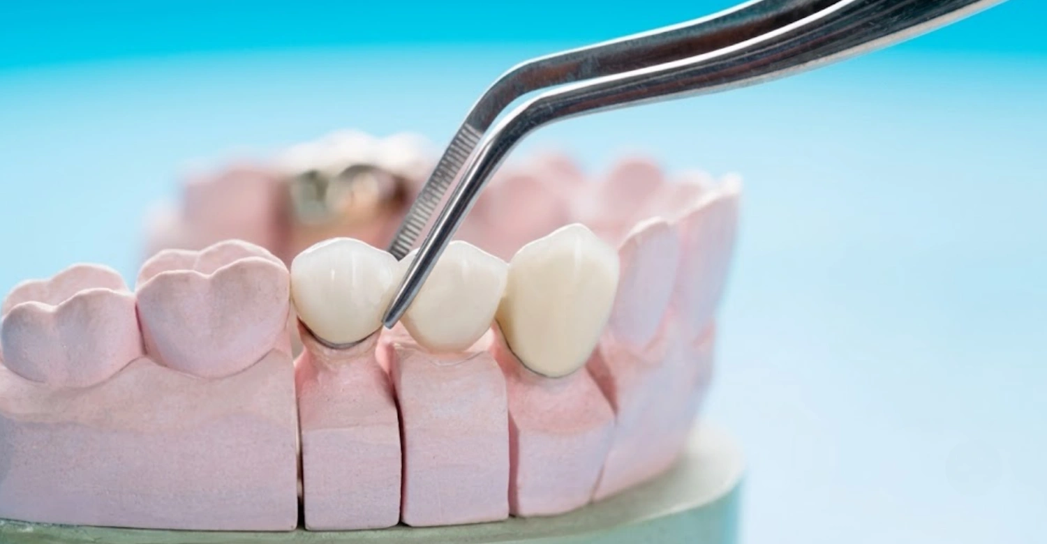 Choose the Best Dental Crown Material Now - Vitrin Clinic
