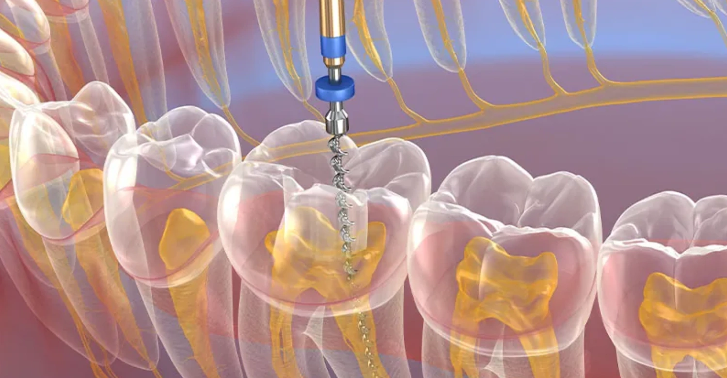 Tri Root Holistic Alternative to Root Canal: Effective Options - Vitrin Clinic
