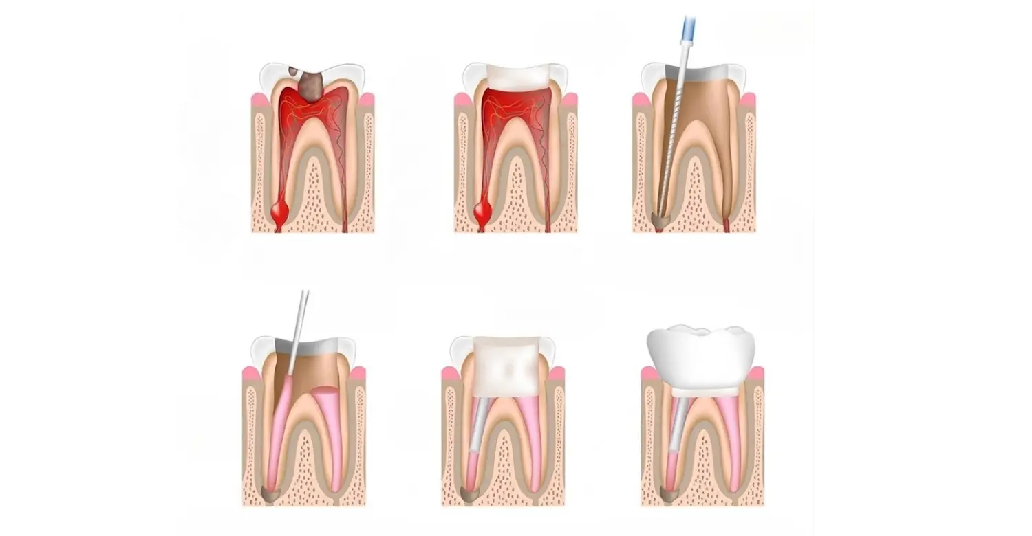 Root Canal for Cracked Tooth Best Treatment Options - Vitrin Clinic