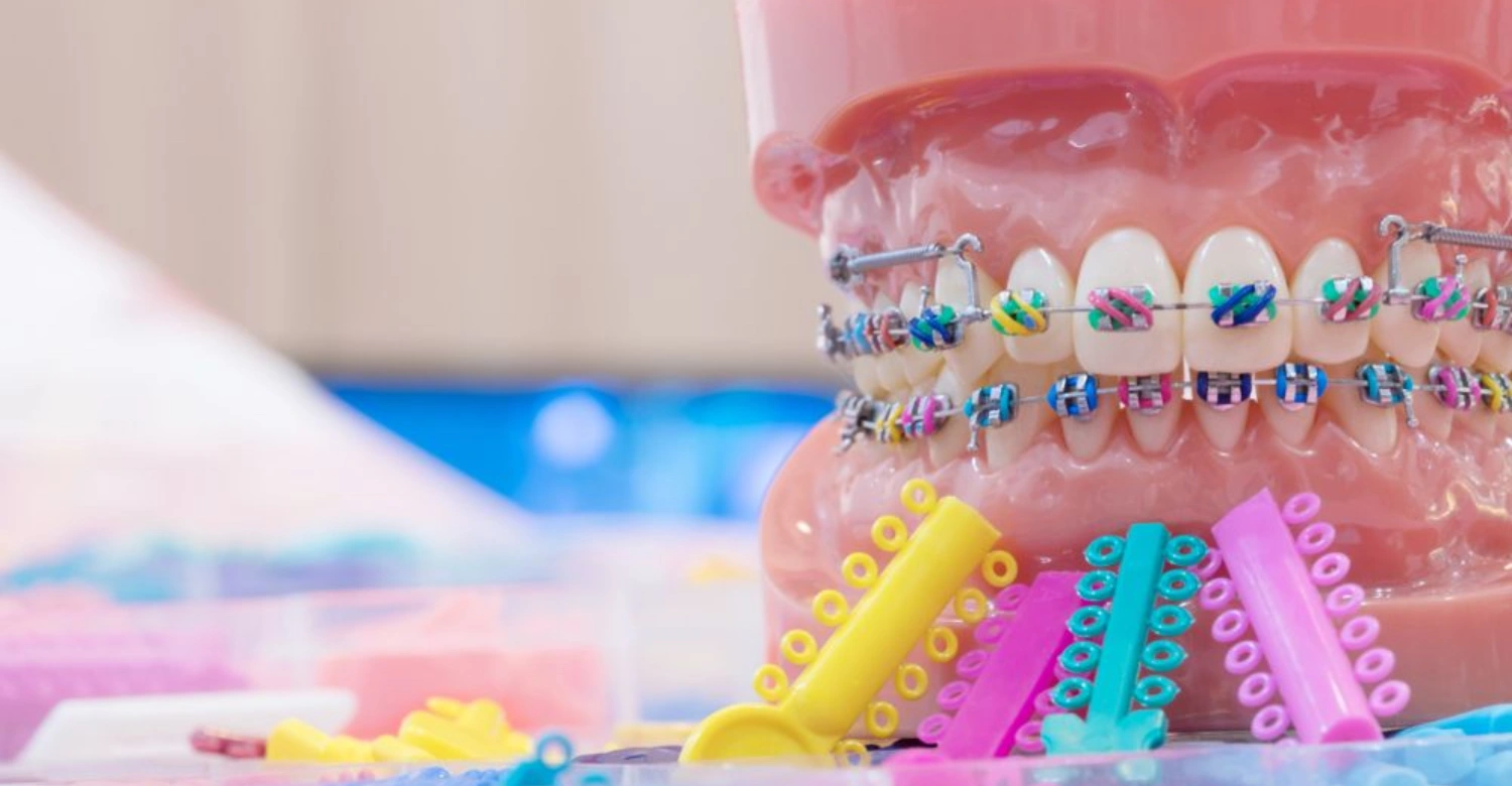 Braces Colors Guide: Aesthetic Selections - Vitrin Clinic