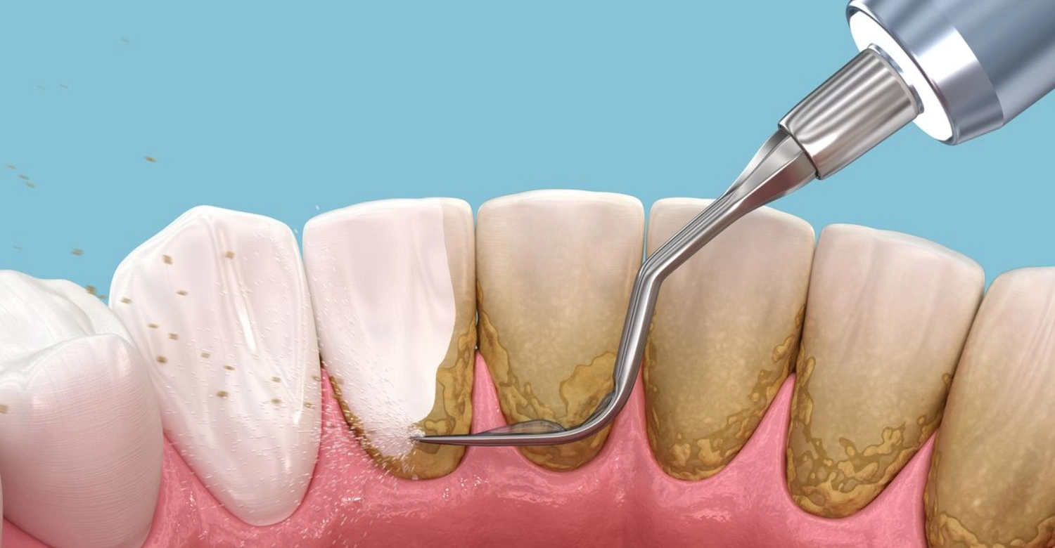 What Should You Pay Attention to After Tartar Removal1