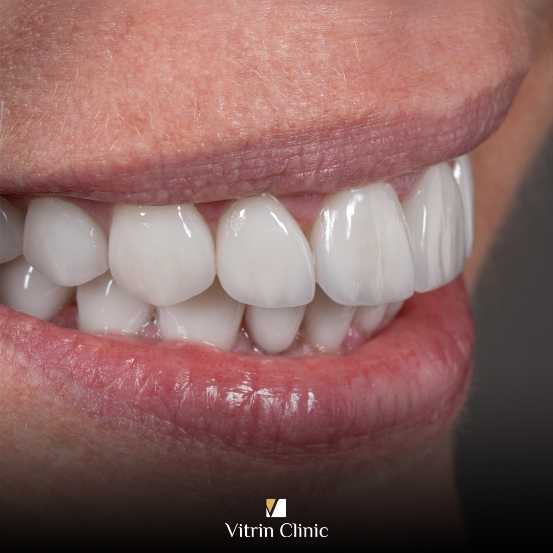 Minimal Prep Veneers :The Conservative Way to a Natural Smile