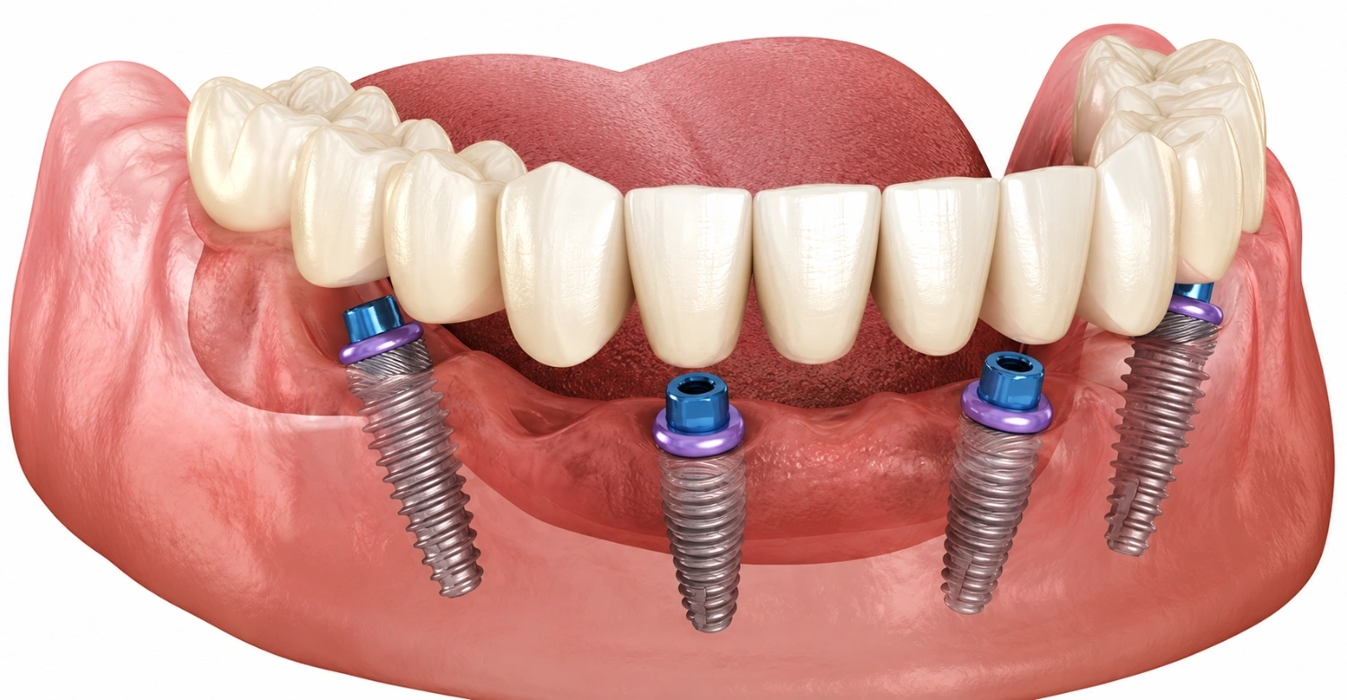 Dentadura fija sobre 4 implantes precio (1)