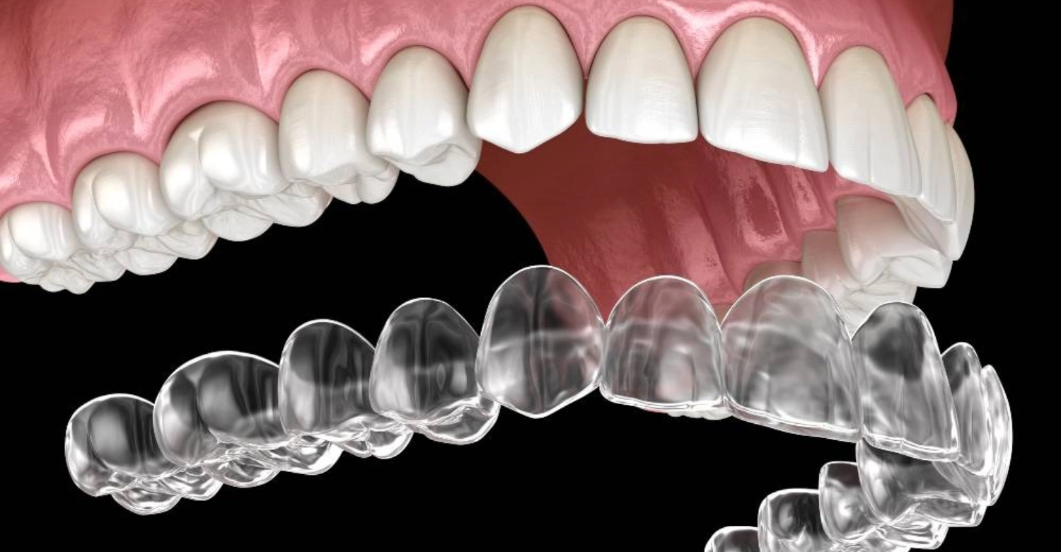 Is Invisalign Bad for Your Teeth? Risks and Realities - Vitrin Clinic