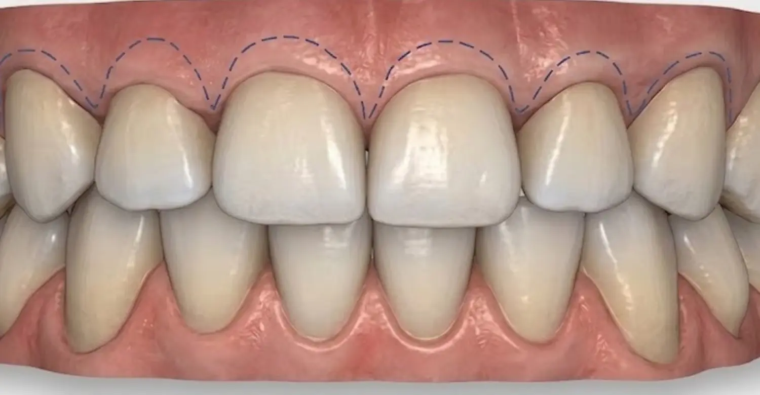 Does gum tissue grow back after contouring