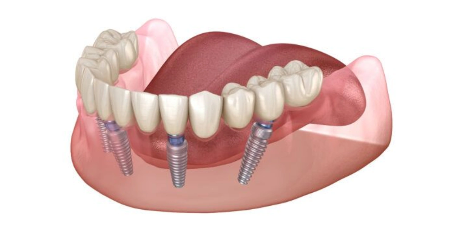 Are all on 4 dental implants1