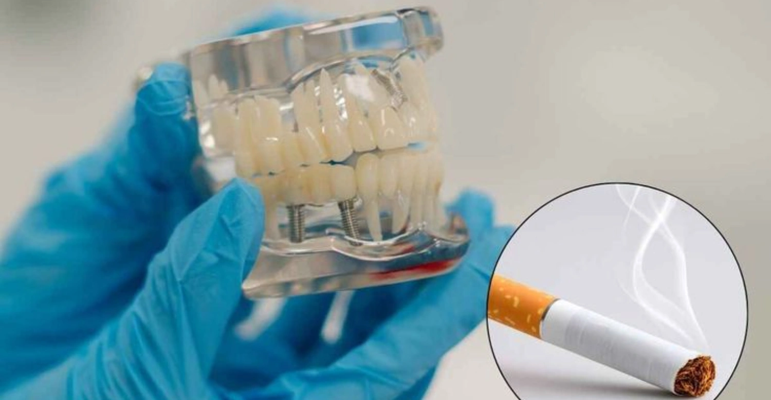 Peut-on fumer aprs la pose d'implants dentaires ? - Vitrin Clinic
