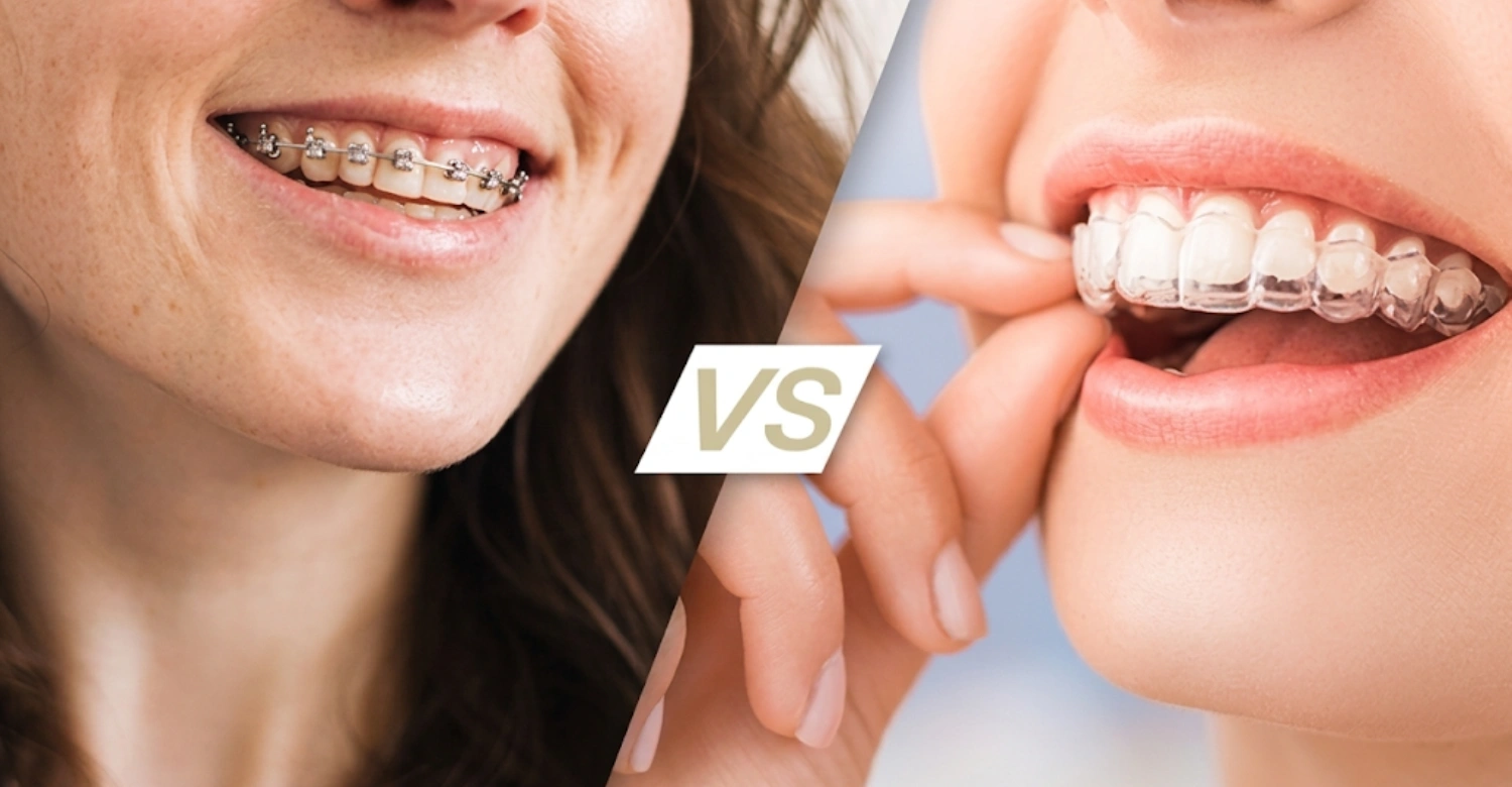 Retainer vs Braces: Costs and Results - Vitrin Clinic