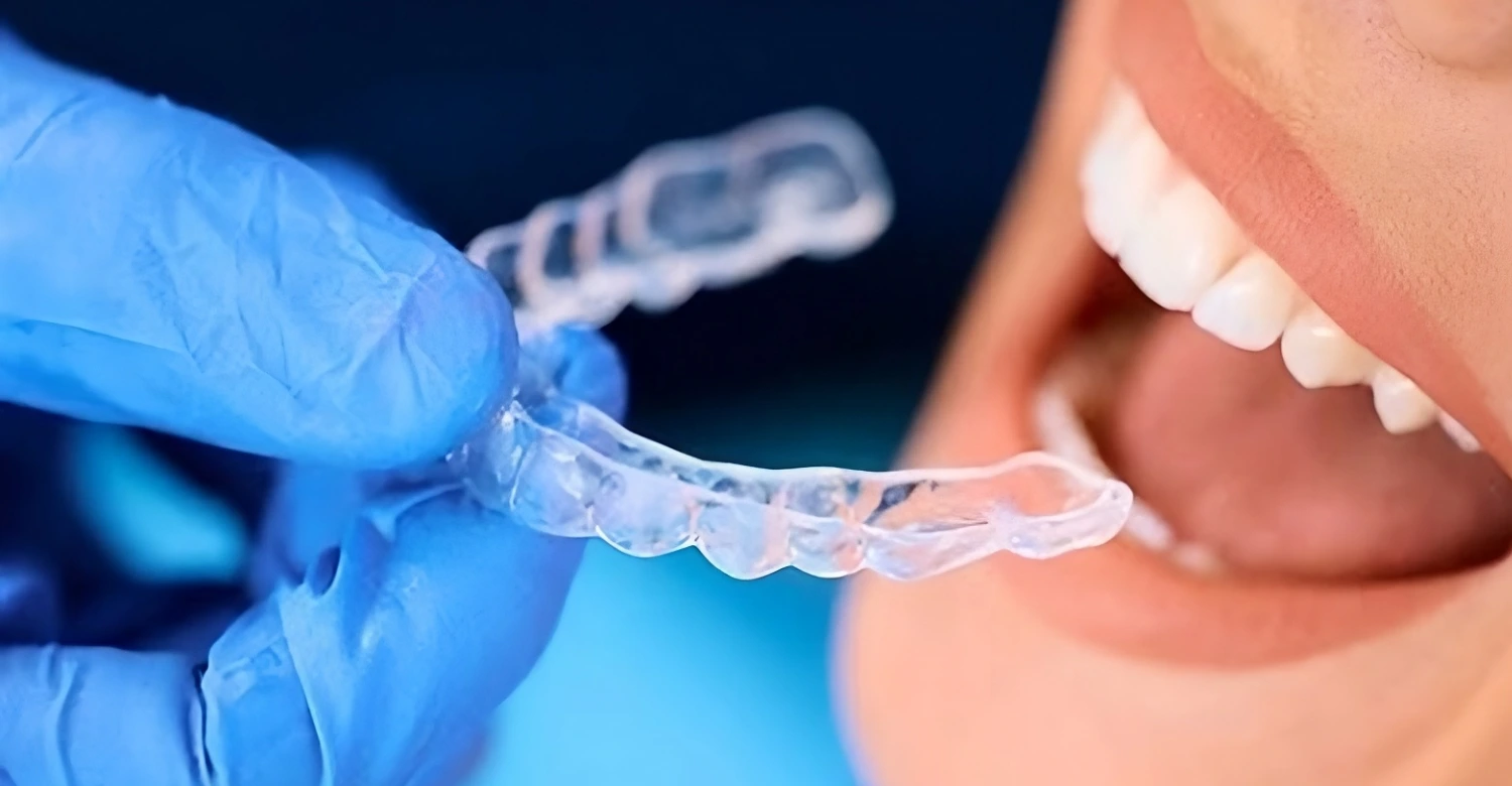 Proven Invisalign refinements for Perfection - Vitrin Clinic