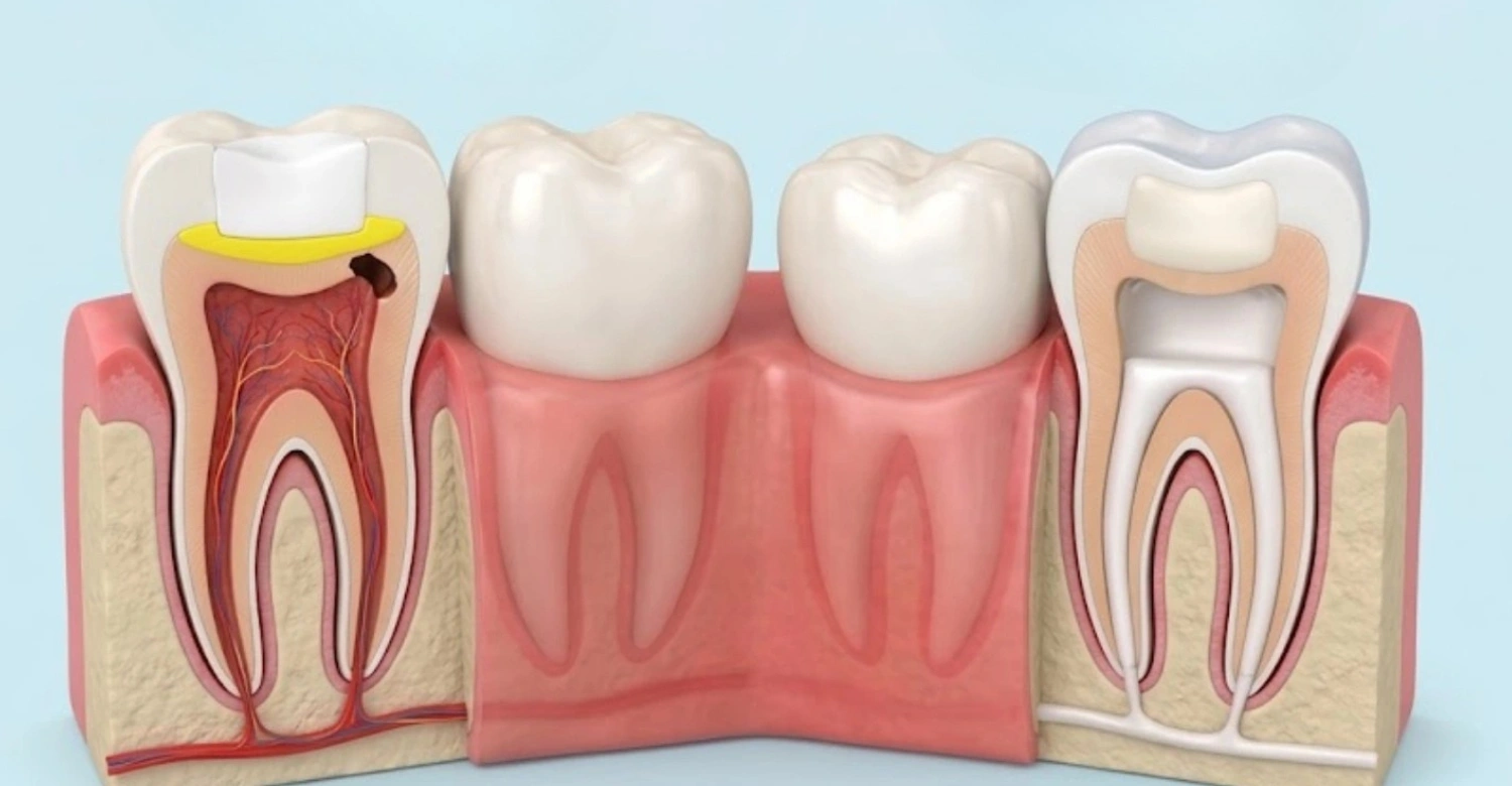 Pulp Capping vs Root Canal Treatment Map - Vitrin Clinic
