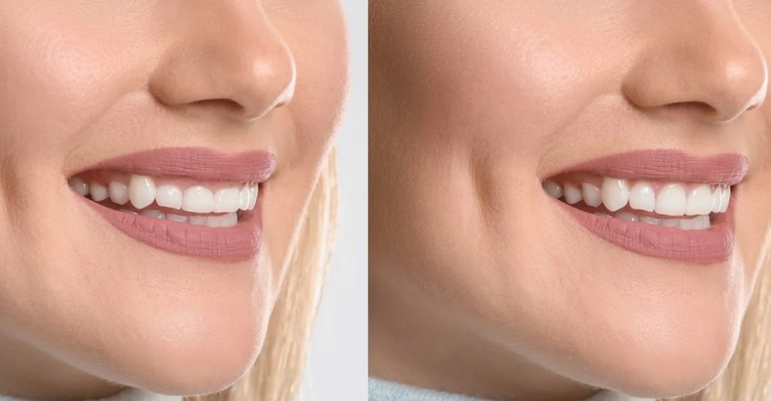 Gum Contouring Recovery Timeline and Aftercare