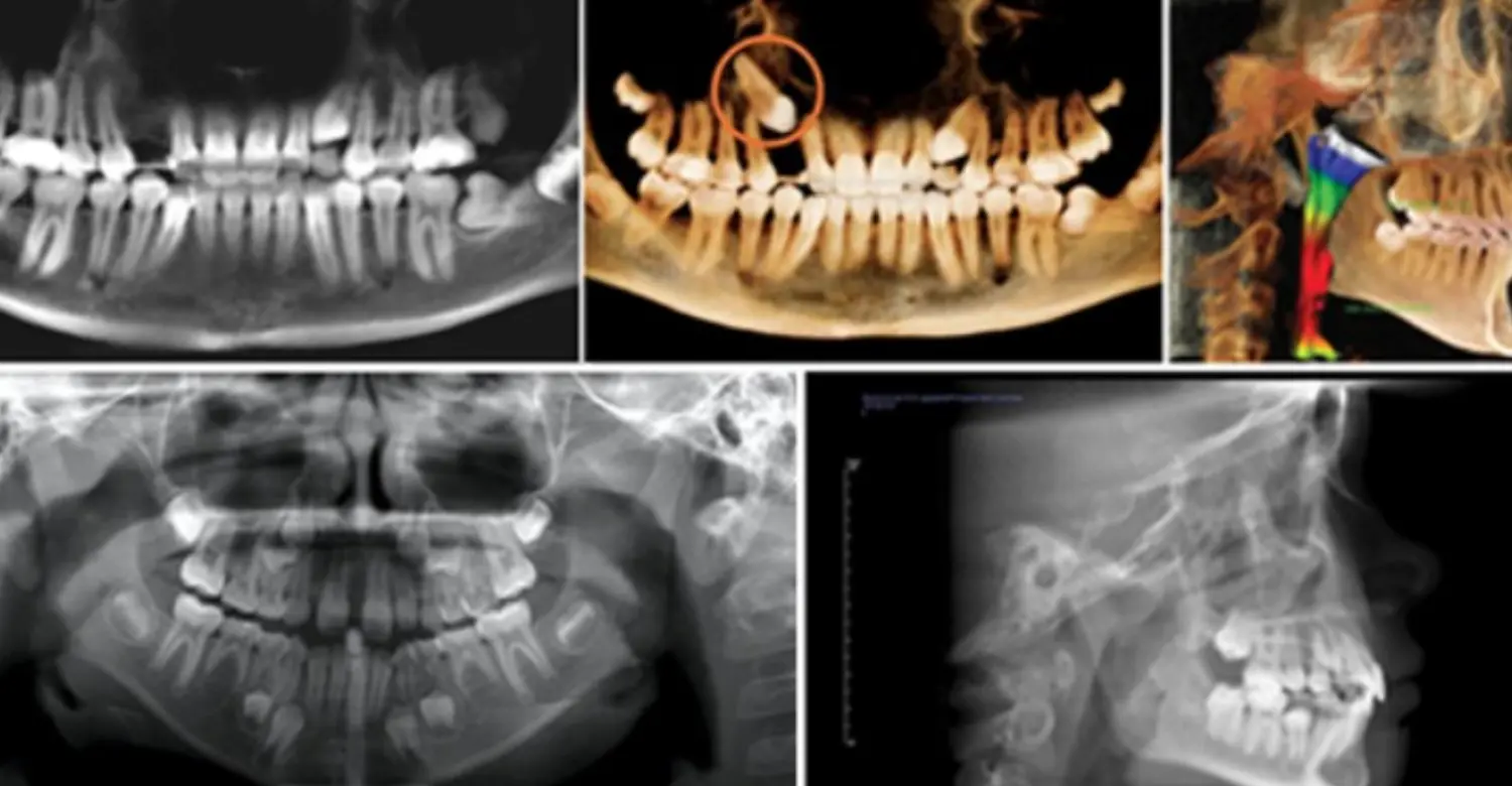 Ray Cone Cone Beam Dental X Ray: ¿Qué es una radiografía dental de haz cónico ...