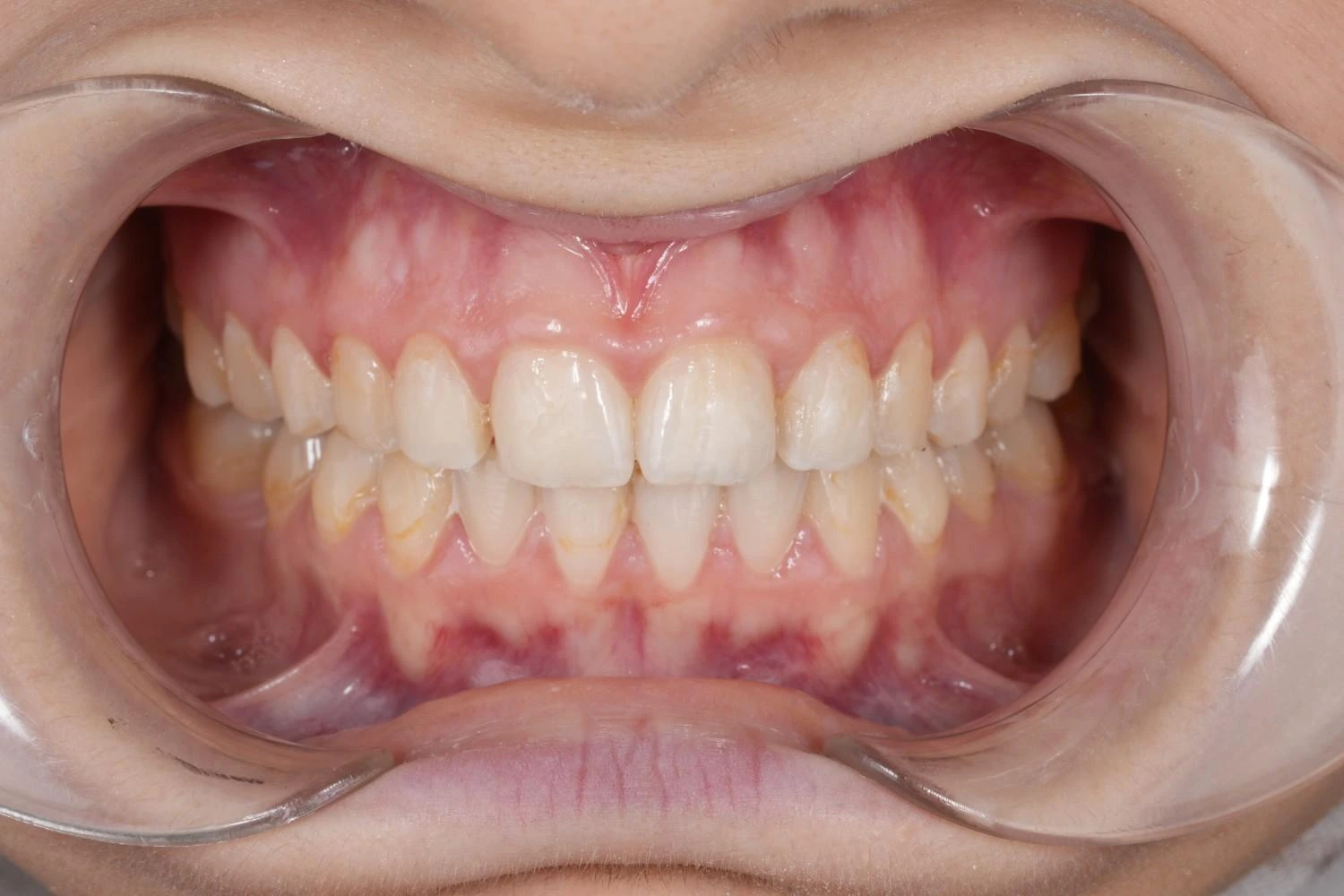 After treatment 1