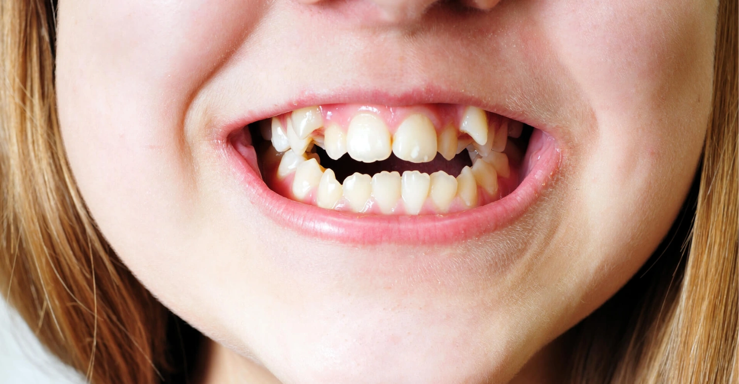 Teeth abnormalities in children