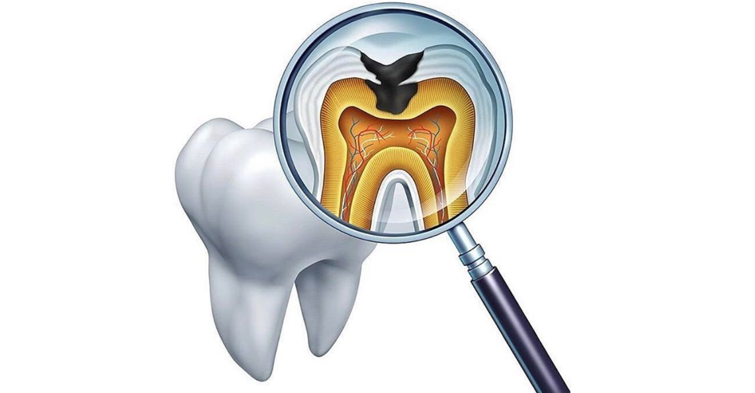 qué ayuda a aliviar el dolor causado por la caries dental1